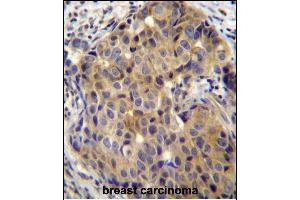 ST14 Antibody (C-term) (ABIN652185 and ABIN2840675) immunohistochemistry analysis in formalin fixed and paraffin embedded human breast carcinoma followed by peroxidase conjugation of the secondary antibody and DAB staining. (ST14 Antikörper  (C-Term))