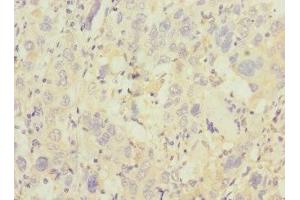 Immunohistochemistry of paraffin-embedded human liver cancer using ABIN7172186 at dilution of 1:100 (TRHDE Antikörper  (AA 62-200))