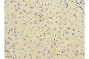 Immunohistochemistry of paraffin-embedded human liver cancer using ABIN7142967 at dilution of 1:100 (CHRNE Antikörper  (AA 21-239))