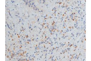 ABIN6268776 at 1/200 staining human breast cancer tissue sections by IHC-P. (MMP 9 Antikörper  (C-Term))