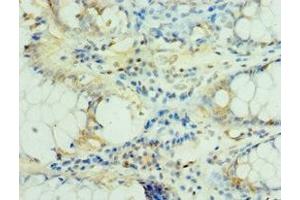Immunohistochemistry of paraffin-embedded human colon cancer using ABIN7159382 at dilution of 1:100 (MS4A12 Antikörper  (AA 1-90))