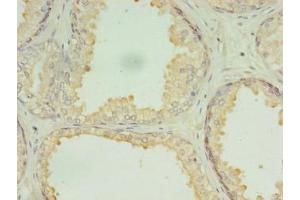 Immunohistochemistry of paraffin-embedded human prostate cancer using ABIN7150902 at dilution of 1:100 (CCDC135 Antikörper  (AA 1-300))