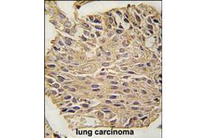 Formalin-fixed and paraffin-embedded human lung carcinoma tissue reacted with ALDOA antibody , which was peroxidase-conjugated to the secondary antibody, followed by DAB staining. (ALDOA Antikörper  (C-Term))