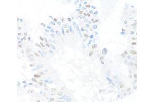 Immunohistochemistry of paraffin-embedded Human mammary cancer using CREM Polyclonal Antibody at dilution of 1:100 (40x lens). (CREM Antikörper)