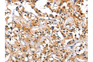 The image on the left is immunohistochemistry of paraffin-embedded Human thyroid cancer tissue using ABIN7128916(CEP97 Antibody) at dilution 1/40, on the right is treated with fusion protein. (CEP97 Antikörper)