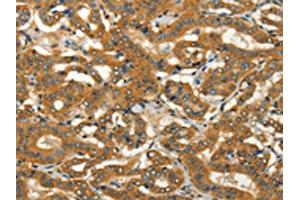 The image on the left is immunohistochemistry of paraffin-embedded Human thyroid cancer tissue using ABIN7128251(ADCY3 Antibody) at dilution 1/50, on the right is treated with fusion protein. (ADCY3 Antikörper)