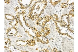 Annexin A2 Mouse Monoclonal Antibody at 1/100 staining human ovarian cancer by IHC-P. (Annexin A2 Antikörper  (Internal Region))
