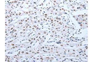 The image on the left is immunohistochemistry of paraffin-embedded Human lung cancer tissue using ABIN7189621(ACIN1 Antibody) at dilution 1/30, on the right is treated with synthetic peptide. (ACIN1 Antikörper)