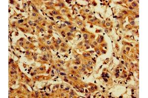 IHC image of ABIN7164696 diluted at 1:200 and staining in paraffin-embedded human liver cancer performed on a Leica BondTM system. (PDCD6 Antikörper  (AA 1-191))