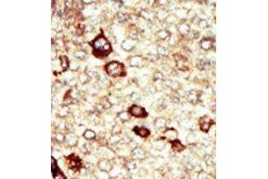 Formalin-fixed and paraffin-embedded human cancer tissue reacted with the primary antibody, which was peroxidase-conjugated to the secondary antibody, followed by AEC staining. (FGFR4 Antikörper  (N-Term))