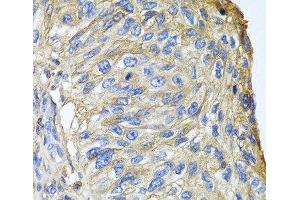 Immunohistochemistry of paraffin-embedded Human prostate cancer using APOA1 Polyclonal Antibody at dilution of 1:100 (40x lens). (APOA1 Antikörper)