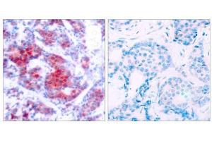 Immunohistochemical analysis of paraffin-embedded human breast carcinoma tissue using STAT4 (phospho-Tyr693) antibody (E011047). (STAT4 Antikörper  (pTyr693))
