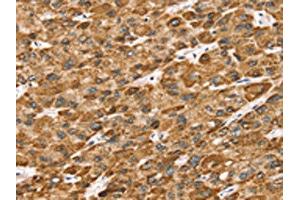 The image on the left is immunohistochemistry of paraffin-embedded Human liver cancer tissue using ABIN7192683(STK32B Antibody) at dilution 1/25, on the right is treated with synthetic peptide. (STK32B Antikörper)