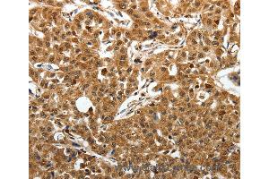 Immunohistochemistry of Human lung cancer using SOX13 Polyclonal Antibody at dilution of 1:50 (SOX13 Antikörper)