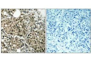 Immunohistochemical analysis of paraffin-embedded human breast carcinoma tissue using G3BP-1 (Ab-232) antibody (E021102). (G3BP1 Antikörper)