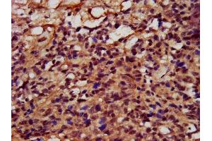 IHC image of ABIN7152727 diluted at 1:400 and staining in paraffin-embedded human ovarian cancer performed on a Leica BondTM system. (FATE1 Antikörper  (AA 1-162))