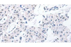 Immunohistochemistry of paraffin-embedded Human lung cancer using POMC Polyclonal Antibody at dilution of 1:30