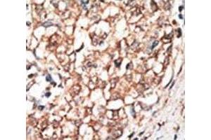 IHC analysis of FFPE human hepatocarcinoma tissue stained with the BMPR1B antibody (BMPR1B Antikörper  (AA 472-502))