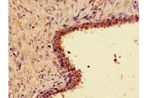 Immunohistochemistry of paraffin-embedded human prostate cancer using ABIN7166309 at dilution of 1:100 (WNT7A Antikörper  (AA 126-302))