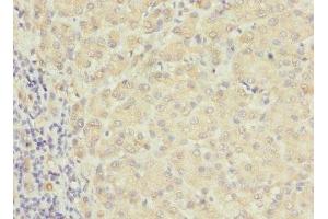 Immunohistochemistry of paraffin-embedded human liver cancer using ABIN7167233 at dilution of 1:100 (RAB17 Antikörper  (AA 1-212))