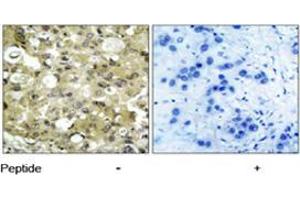 Immunohistochemical analysis of paraffin-embedded human breast carcinoma tissue using KDR polyclonal antibody  . (VEGFR2/CD309 Antikörper)