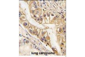 Paraformaldehyde-fixed, paraffin embedded human lung carcinoma tissue, Antigen retrieval by boiling in sodium citrate buffer (pH6. (EPH Receptor B2 Antikörper)