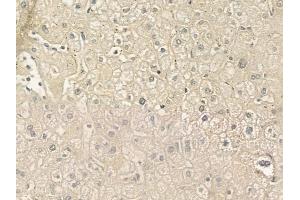 ABIN6258768 and ABIN6275107 at 1/100 staining human hepatocellular carcinoma by IHC-P. (ELOVL5 Antikörper  (C-Term))