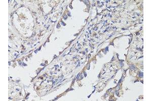 Immunohistochemistry of paraffin-embedded human lung cancer using NTRK2 antibody (ABIN5998390) at dilution of 1/200 (40x lens). (TRKB Antikörper)
