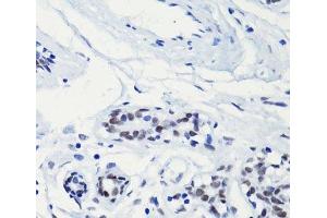 Immunohistochemistry of paraffin-embedded Human breast using Acetyl-Histone H2A-K5 Polyclonal Antibody at dilution of 1:100 (40x lens). (Histone H2A Antikörper  (acLys5))