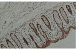 Immunohistochemistry of paraffin-embedded Human colon carcinoma tissue using HSP90 alpha Monoclonal Antibody at dilution of 1:200. (HSP90AA2 Antikörper)