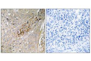 Immunohistochemistry analysis of paraffin-embedded human lung carcinoma tissue, using SC6A6 antibody. (TAUT Antikörper  (C-Term))