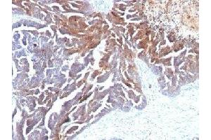 Formalin-fixed, paraffin-embedded human ovarian carcinoma stained with TAG-72 antibody (B72. (TAG-72 Antikörper)