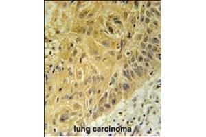 WNT5A Antibody (Center) (ABIN651869 and ABIN2840430) immunohistochemistry analysis in formalin fixed and paraffin embedded human lung carcinoma followed by peroxidase conjugation of the secondary antibody and DAB staining.