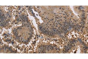 Immunohistochemistry of paraffin-embedded Human colon cancer tissue using JAG2 Polyclonal Antibody at dilution 1:30 (JAG2 Antikörper)