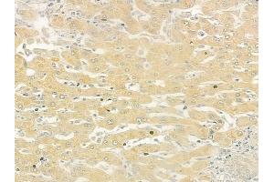 ABIN6260830 and ABIN6279242 at 1/100 staining human hepatocellular carcinoma by IHC-P. (CHST12 Antikörper  (C-Term))