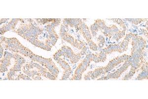 Immunohistochemistry of paraffin-embedded Human thyroid cancer tissue using ACSF2 Polyclonal Antibody at dilution of 1:30(x200) (ACSF2 Antikörper)