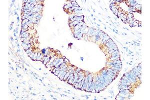 Immunohistochemistry of paraffin-embedded human colon carcinoma using PDHB Rabbit mAb (ABIN7269772) at dilution of 1:100 (40x lens).