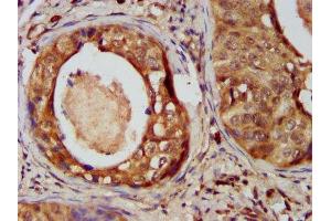 IHC image of ABIN7148726 diluted at 1:400 and staining in paraffin-embedded human cervical cancer performed on a Leica BondTM system. (CSMD3 Antikörper  (AA 233-380))