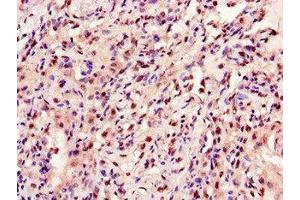 Immunohistochemistry of paraffin-embedded human lung cancer using ABIN7144222 at dilution of 1:100 (ANKRD23 Antikörper  (AA 1-200))