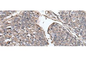 Immunohistochemistry of paraffin-embedded Human liver cancer tissue using PRUNE Polyclonal Antibody at dilution of 1:40(x200) (PRUNE Antikörper)