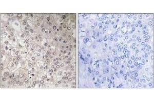 Immunohistochemistry analysis of paraffin-embedded human liver carcinoma tissue, using GIPR Antibody. (GIPR Antikörper  (AA 93-142))