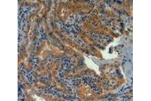 IHC-P analysis of Human Thyroid Cancer Tissue, with DAB staining. (LPCAT3 Antikörper  (AA 122-233))