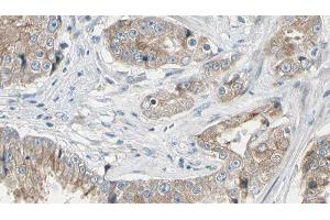ABIN6278588 at 1/100 staining Human prostate tissue by IHC-P. (GAL4 Antikörper  (N-Term))