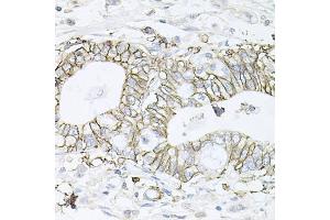 Immunohistochemistry of paraffin-embedded human gastric cancer using B1 antibody (ABIN6127389, ABIN6137306, ABIN6137309 and ABIN6221475) at dilution of 1:100 (40x lens). (ATP1B1 Antikörper  (AA 63-303))