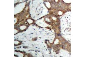 Immunohistochemical analysis of Androgen Receptor staining in human prostate cancer formalin fixed paraffin embedded tissue section. (Androgen Receptor Antikörper)
