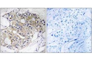 Immunohistochemistry analysis of paraffin-embedded human breast carcinoma tissue, using DHRS4 Antibody. (DHRS4 Antikörper  (AA 191-240))