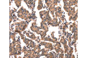 Immunohistochemistry of Human liver cancer using CGA Polyclonal Antibody at dilution of 1:65 (hCG Antikörper)