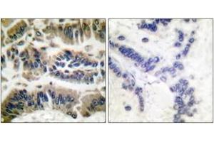 Immunohistochemistry analysis of paraffin-embedded human breast carcinoma tissue, using Caspase 6 (Ab-257) Antibody. (Caspase 6 Antikörper  (AA 223-272))