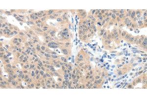 Immunohistochemistry of paraffin-embedded Human ovarian cancer tissue using SLC20A1 Polyclonal Antibody at dilution 1:40 (SLC20A1 Antikörper)
