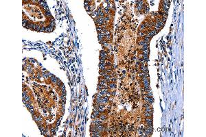 Immunohistochemistry of Human esophagus cancer using ITGA7 Polyclonal Antibody at dilution of 1:35
